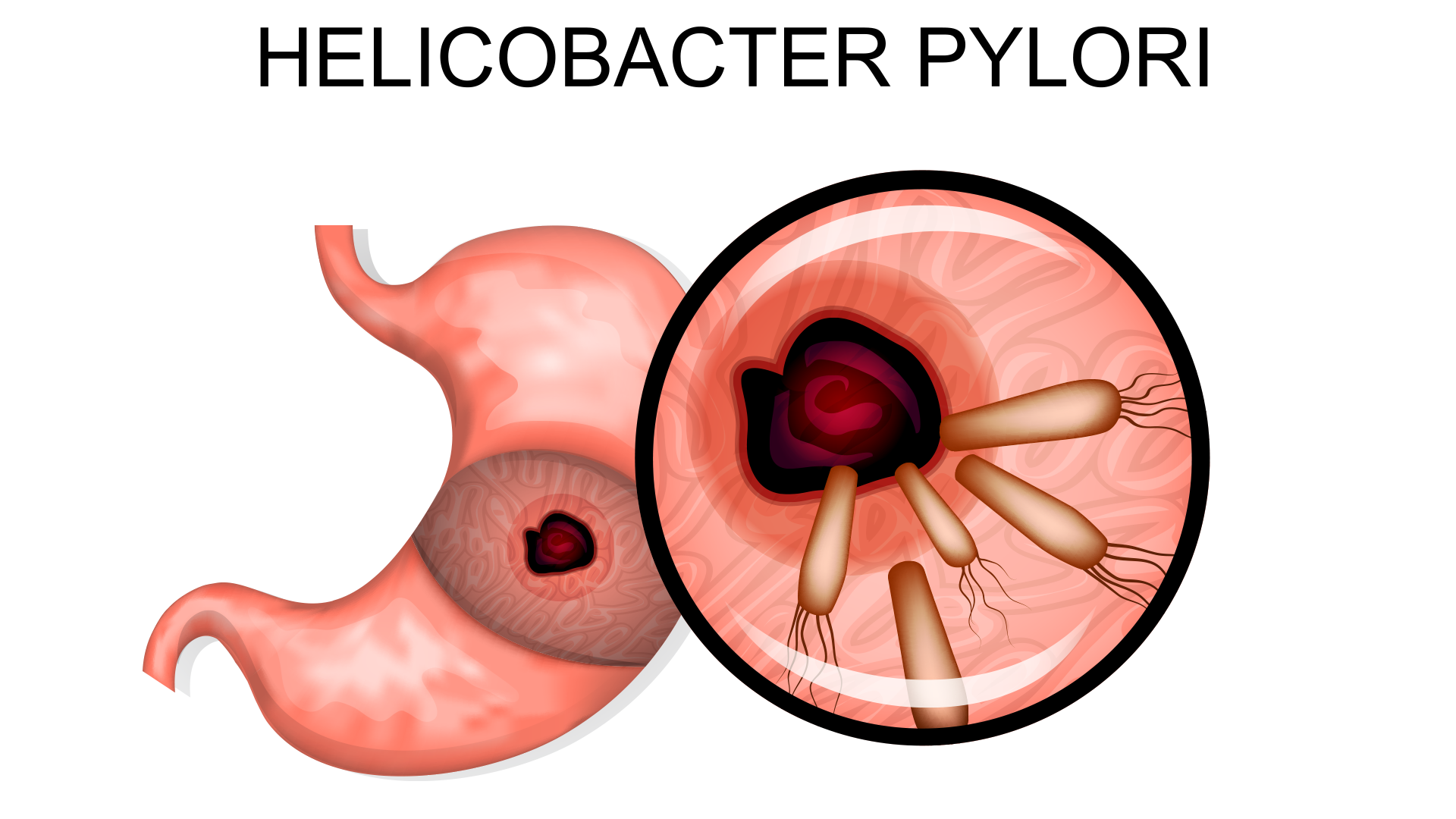 helicobacter